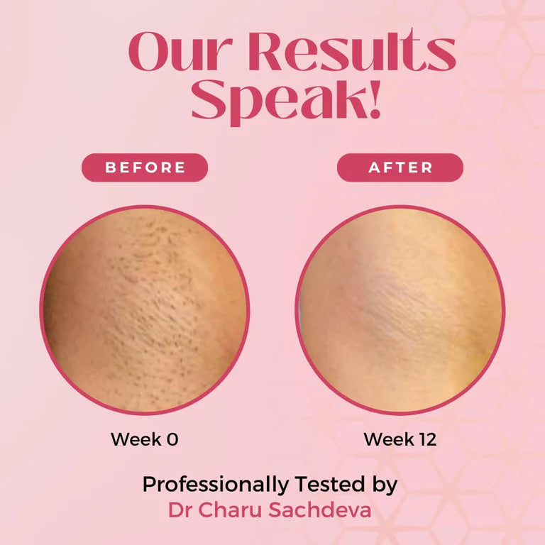 IPL Laser Hair Removal by Sanshi Mart